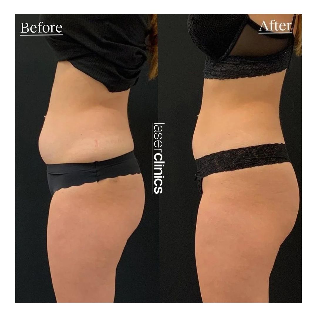 COOLSCULPTING.jpg